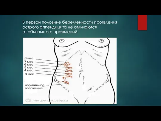 В первой половине беременности проявления острого аппендицита не отличаются от обычных его проявлений