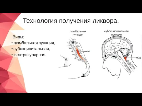 Технология получения ликвора. Виды: люмбальная пункция, субокципитальная, вентрикулярная.