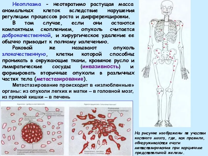 Неоплазма - неотвратимо растущая масса аномальных клеток вследствие нарушения регуляции процессов роста