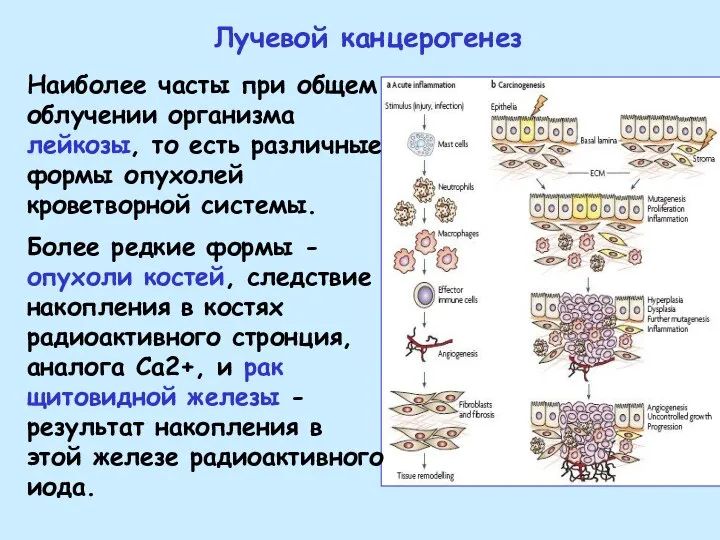 Лучевой канцерогенез Наиболее часты при общем облучении организма лейкозы, то есть различные