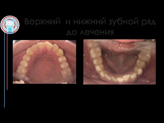 Верхний и нижний зубной ряд до лечения Справа: дефицит места 1 мм