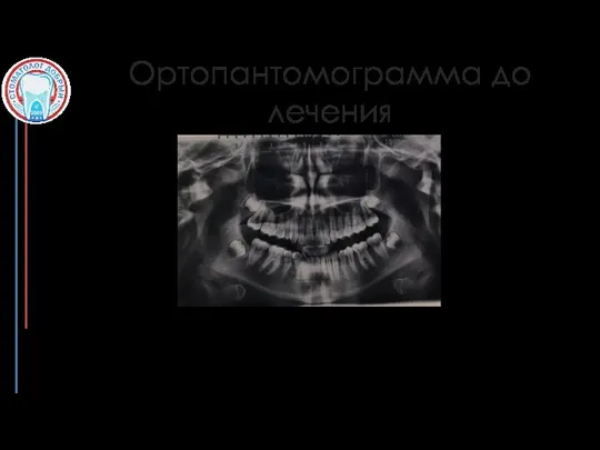 Ортопантомограмма до лечения Особенности: имеются зачатки 1.8 2.8 3.8 4.8 зубов