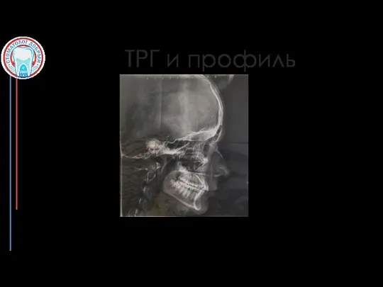 ТРГ и профиль Наклон резцов: ретроположение вч 7, макро вч 5мм; ретроположение