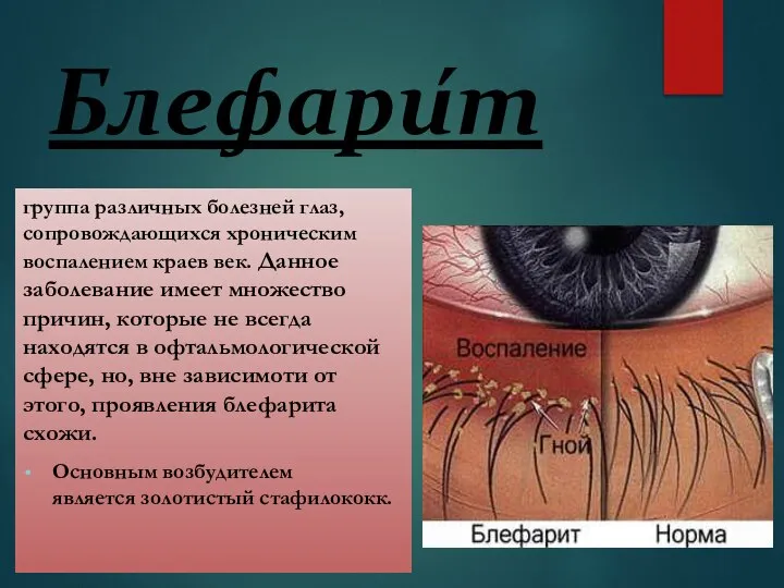 Блефари́т группа различных болезней глаз, сопровождающихся хроническим воспалением краев век. Данное заболевание