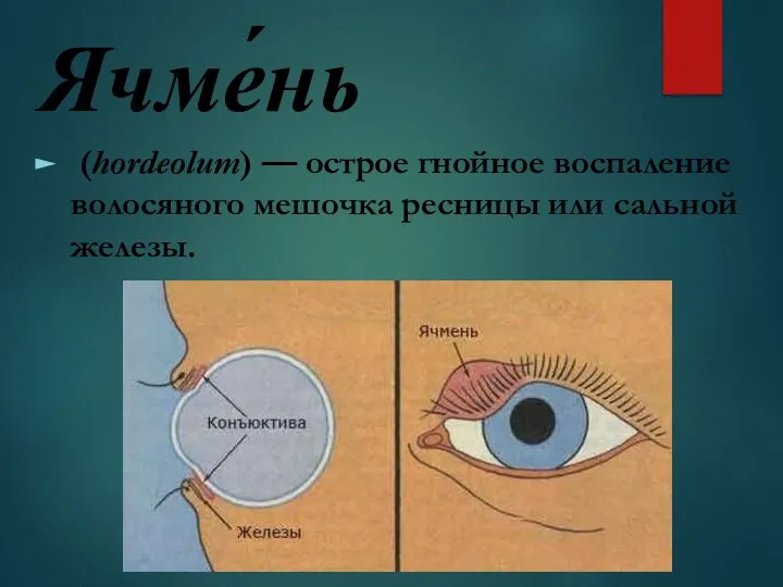 Ячме́нь (hordeolum) — острое гнойное воспаление волосяного мешочка ресницы или сальной железы.