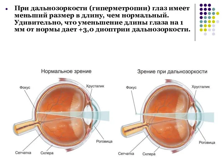 При дальнозоркости (гиперметропии) глаз имеет меньший размер в длину, чем нормальный. Удивительно,