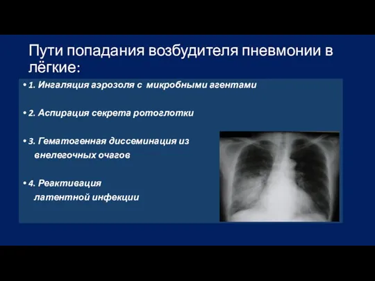 Пути попадания возбудителя пневмонии в лёгкие: 1. Ингаляция аэрозоля с микробными агентами
