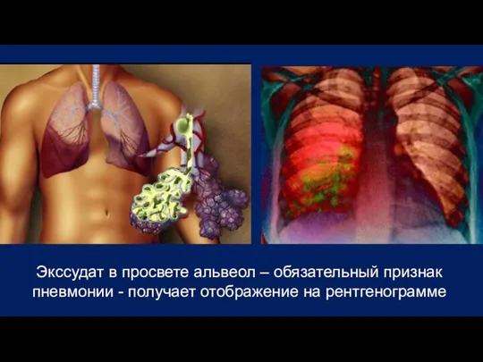 Экссудат в просвете альвеол – обязательный признак пневмонии - получает отображение на рентгенограмме