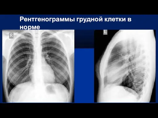 Рентгенограммы грудной клетки в норме