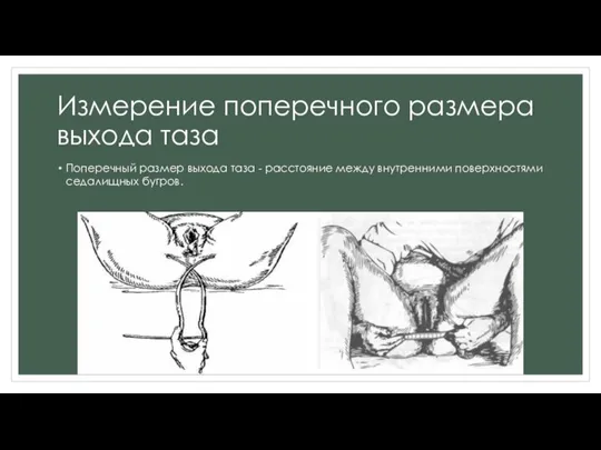 Измерение поперечного размера выхода таза Поперечный размер выхода таза - расстояние между внутренними поверхностями седалищных бугров.