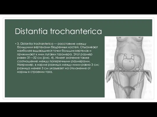 Distantia trochanterica 3. Distantia trochanterica — расстояние между большими вертелами бедренных костей.