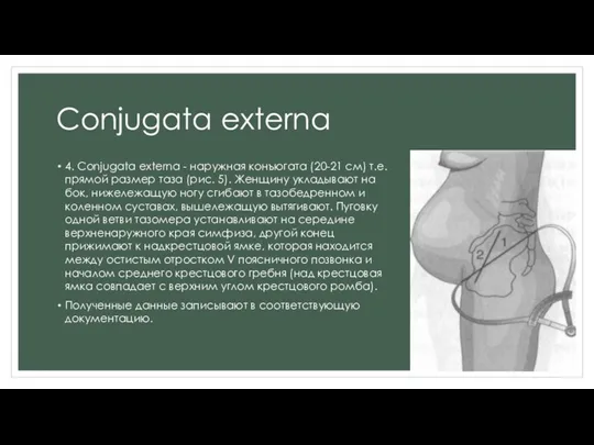 Conjugata externa 4. Conjugata externa - наружная конъюгата (20-21 см) т.е. прямой