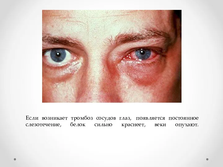 Если возникает тромбоз сосудов глаз, появляется постоянное слезотечение, белок сильно краснеет, веки опухают.