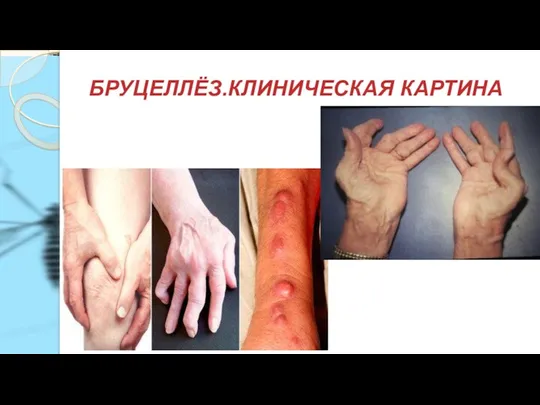 БРУЦЕЛЛЁЗ.КЛИНИЧЕСКАЯ КАРТИНА