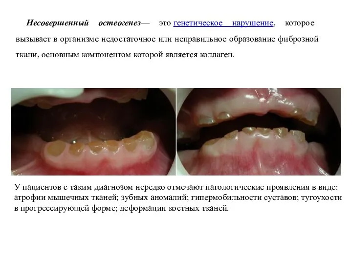 Несовершенный остеогенез— это генетическое нарушение, которое вызывает в организме недостаточное или неправильное