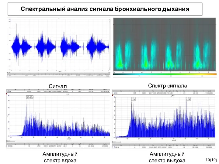 Спектральный анализ сигнала бронхиального дыхания 10(10) Сигнал Спектр сигнала Амплитудный спектр вдоха Амплитудный спектр выдоха