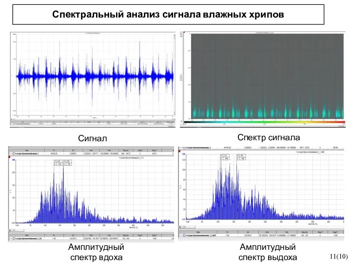 Спектральный анализ сигнала влажных хрипов 11(10) Сигнал Спектр сигнала Амплитудный спектр вдоха Амплитудный спектр выдоха