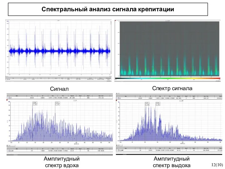 Спектральный анализ сигнала крепитации 12(10) Сигнал Спектр сигнала Амплитудный спектр вдоха Амплитудный спектр выдоха