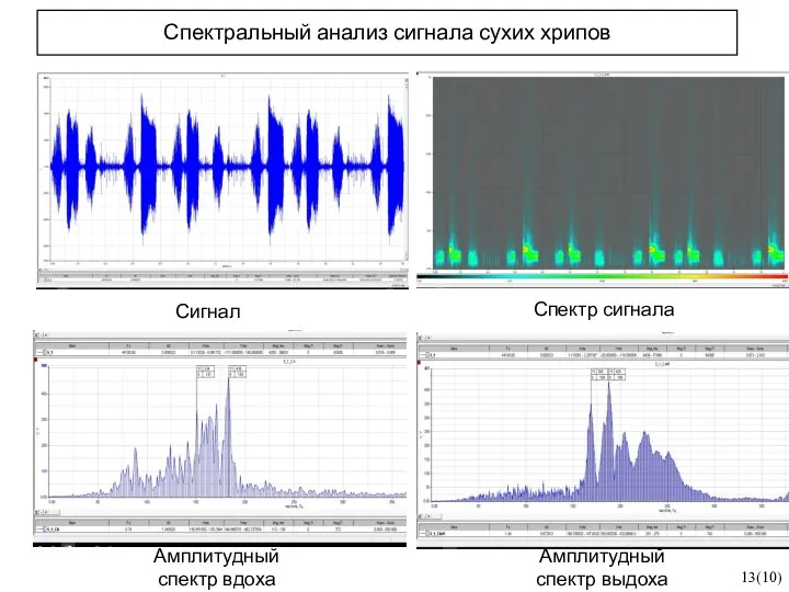 Спектральный анализ сигнала сухих хрипов 13(10) Сигнал Спектр сигнала Амплитудный спектр вдоха Амплитудный спектр выдоха