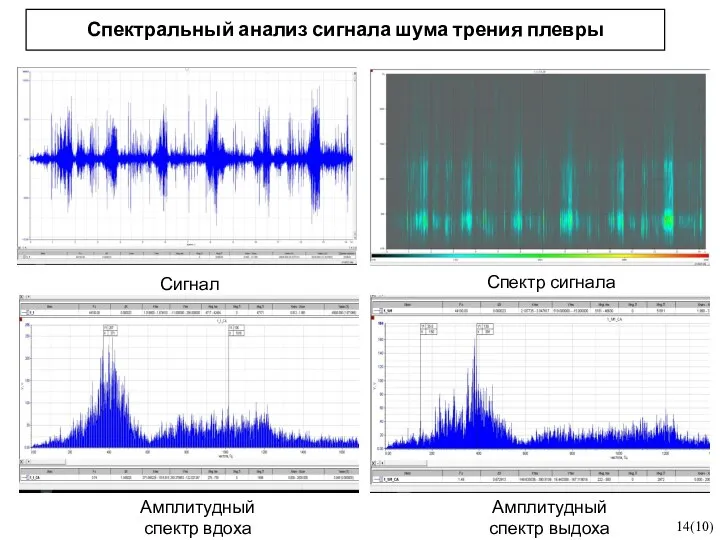 Спектральный анализ сигнала шума трения плевры 14(10) Сигнал Спектр сигнала Амплитудный спектр вдоха Амплитудный спектр выдоха