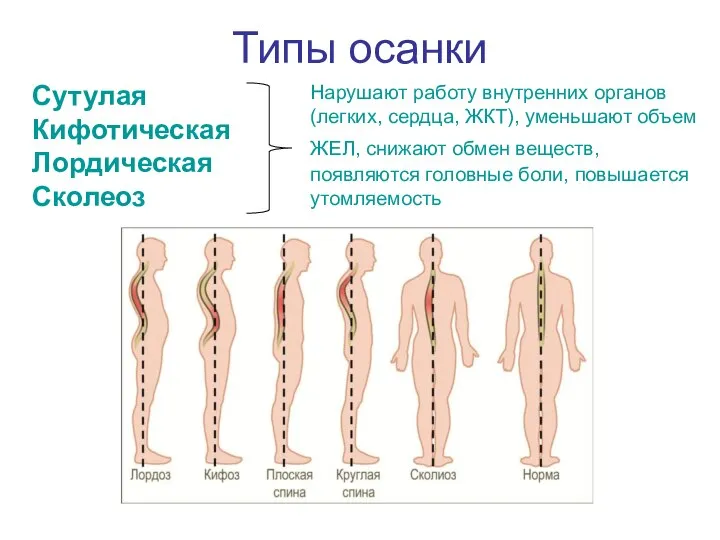 Типы осанки Сутулая Кифотическая Лордическая Сколеоз Нарушают работу внутренних органов (легких, сердца,