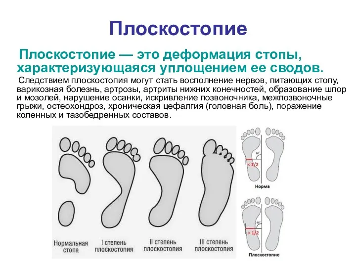 Плоскостопие Плоскостопие — это деформация стопы, характеризующаяся уплощением ее сводов. Следствием плоскостопия