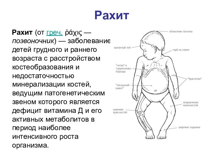 Рахит Рахит (от греч. ῥάχις —позвоночник) — заболевание детей грудного и раннего