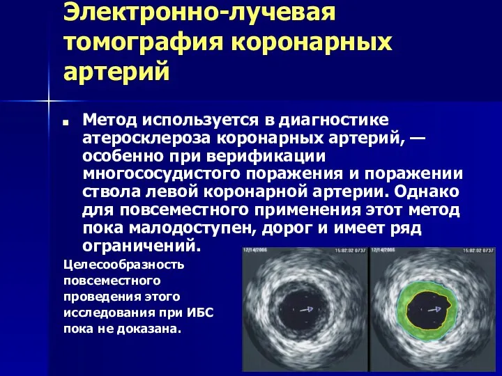 Электронно-лучевая томография коронарных артерий Метод используется в диагностике атеросклероза коронарных артерий, —