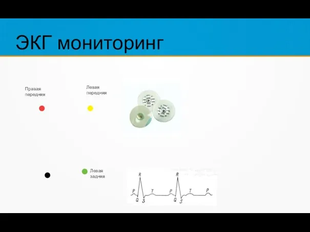 ЭКГ мониторинг Левая задняя Левая передняя Правая передняя