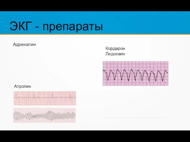 ЭКГ - препараты Адреналин Атропин Кордарон Лидокаин