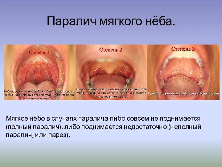 Паралич мягкого нёба. Мягкое нёбо в случаях паралича либо совсем не поднимается