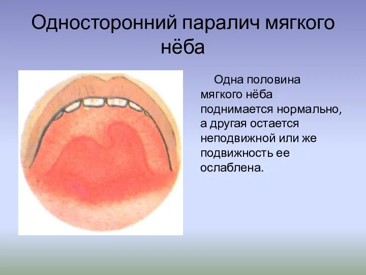 Односторонний паралич мягкого нёба Одна половина мягкого нёба поднимается нормально, а другая