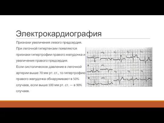 Электрокардиография Признаки увеличения левого предсердия. При легочной гипертензии появляются признаки гипертрофии правого