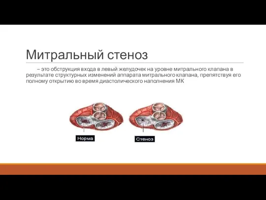 Митральный стеноз – это обструкция входа в левый желудочек на уровне митрального