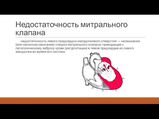 Недостаточность митрального клапана недостаточность левого предсердно-желудочкового отверстия — несмыкание (или неполное смыкание)