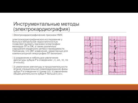 Инструментальные методы (электрокардиография) Электрокардиографические признаки НМК: электрокардиографическое исследование у больных митральной недостаточностью