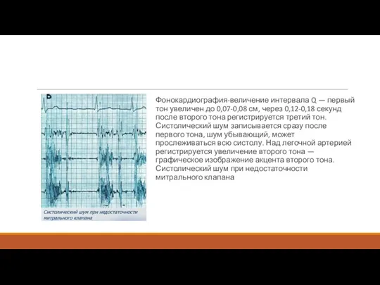 Фонокардиография-величение интервала Q — первый тон увеличен до 0,07-0,08 см, через 0,12-0,18