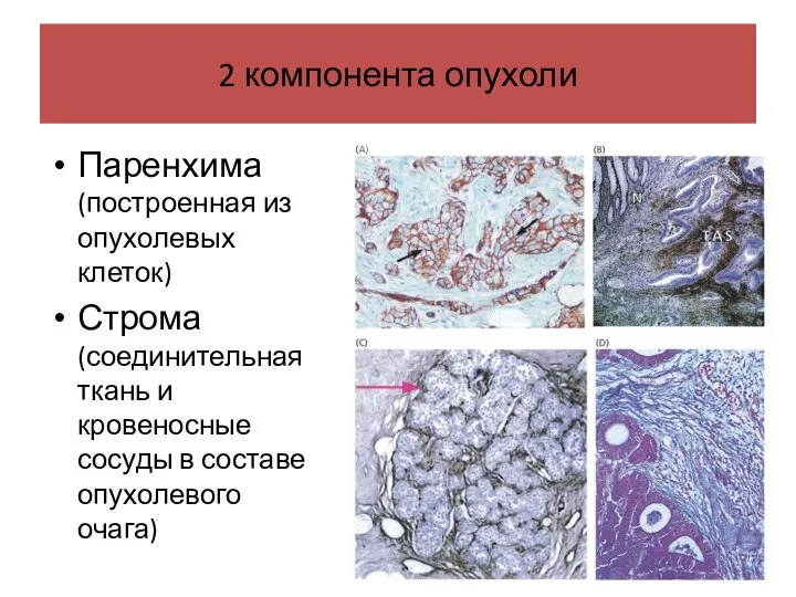 2 компонента опухоли Паренхима (построенная из опухолевых клеток) Строма (соединительная ткань и