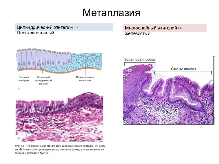 Метаплазия Цилиндрический эпителий -> Плоскоклеточный Многослойный эпителий -> железистый