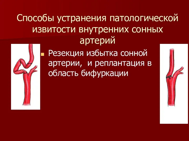 Способы устранения патологической извитости внутренних сонных артерий Резекция избытка сонной артерии, и реплантация в область бифуркации