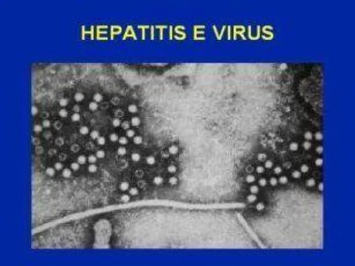 Гепатит - Е Возбудитель заболевания – фильтрующийся вирус. Он не имеет хронических