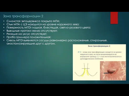 Зона трансформации 2 Слизистая эктоцервикса покрыта МПА; Стык МПА с ЦЭ находится