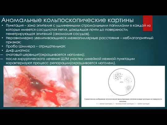 Аномальные кольпоскопические картины Пунктация – зона эпителия с удлиненными стромальными папиллами в