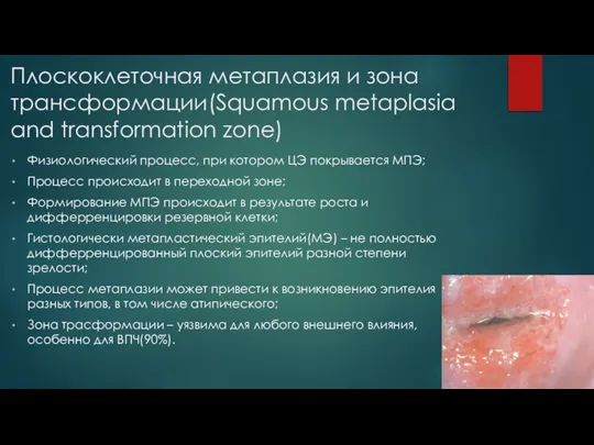 Плоскоклеточная метаплазия и зона трансформации(Squamous metaplasia and transformation zone) Физиологический процесс, при