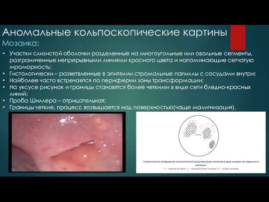 Аномальные кольпоскопические картины Мозаика: Участки слизистой оболочки разделенные на многоугольные или овальные