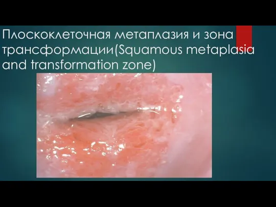 Плоскоклеточная метаплазия и зона трансформации(Squamous metaplasia and transformation zone)