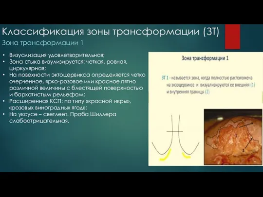 Классификация зоны трансформации (ЗТ) Визуализация удовлетворительная; Зона стыка визулизируется: четкая, ровная, циркулярная;