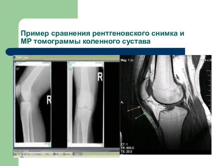 Пример сравнения рентгеновского снимка и МР томограммы коленного сустава