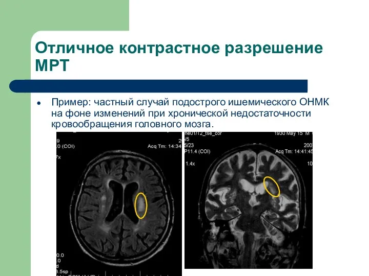 Отличное контрастное разрешение МРТ Пример: частный случай подострого ишемического ОНМК на фоне