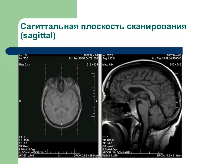 Сагиттальная плоскость сканирования (sagittal)